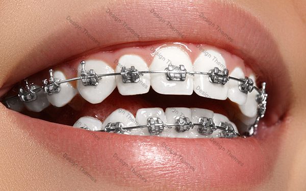 A close up of teeth with braces on them