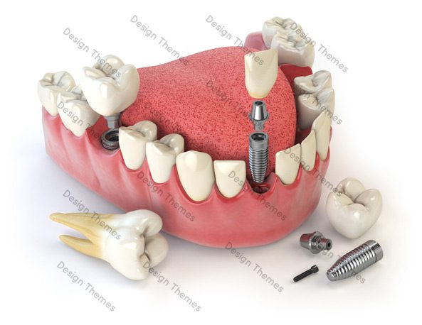 A model of an implant supported denture.