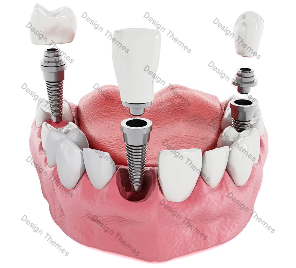 A model of the teeth and implants in it.