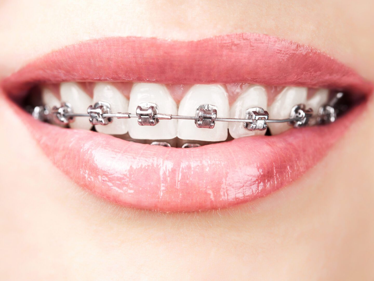 A woman with braces on her teeth is smiling.