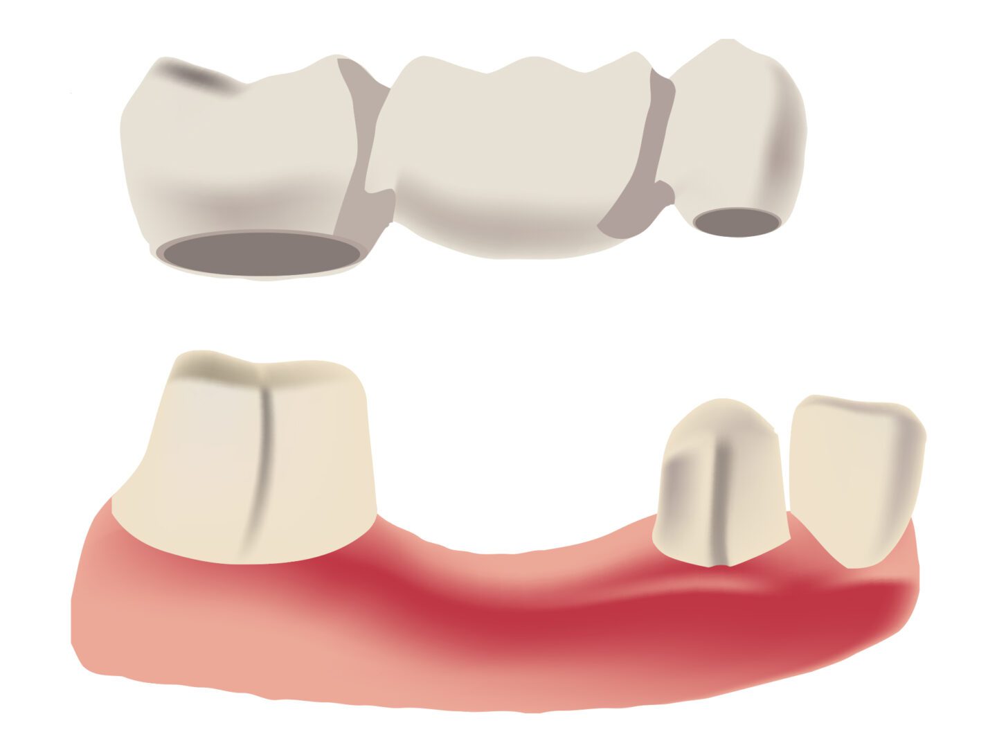 A diagram of the process of dental crowns and bridges.