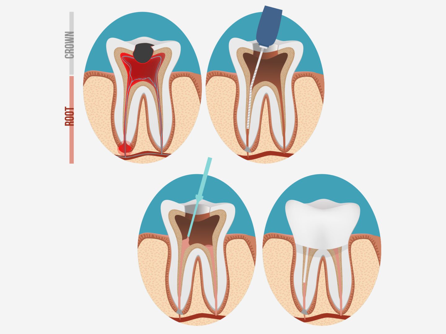 A tooth with different stages of decay and plaque.