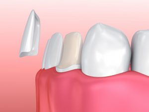 A close up of teeth with porcelain veneers